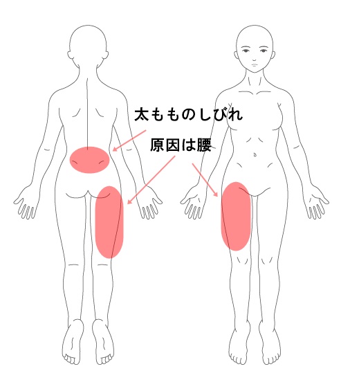 太もものシビレの原因は腰だった 東大阪市河内小阪の整体院 からだリカバリーラボ