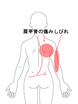肩甲骨付近におこる背中のしびれになる3つの原因 東大阪市河内小阪の整体院 からだリカバリーラボ