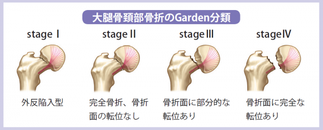大腿骨頚部骨折