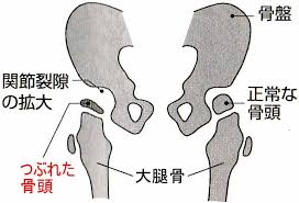 ペルテス病