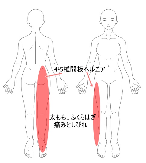 施術改善例 リリカを飲んでもツラい腰椎椎間板ヘルニアが改善した例 東大阪市河内小阪の整体院 からだリカバリーラボ