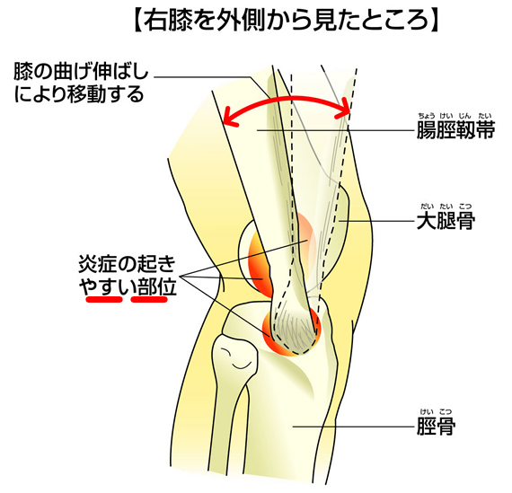 腸脛靭帯炎・ランナー膝（ランナーズニー）とは