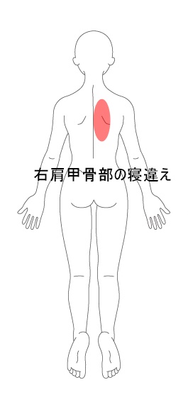 背中 寝違え