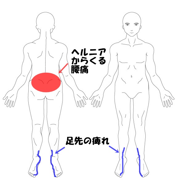 ヘルニア 足 の 裏 痺れ